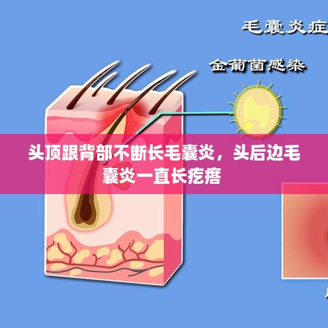 頭頂跟背部不斷長毛囊炎，頭后邊毛囊炎一直長疙瘩 